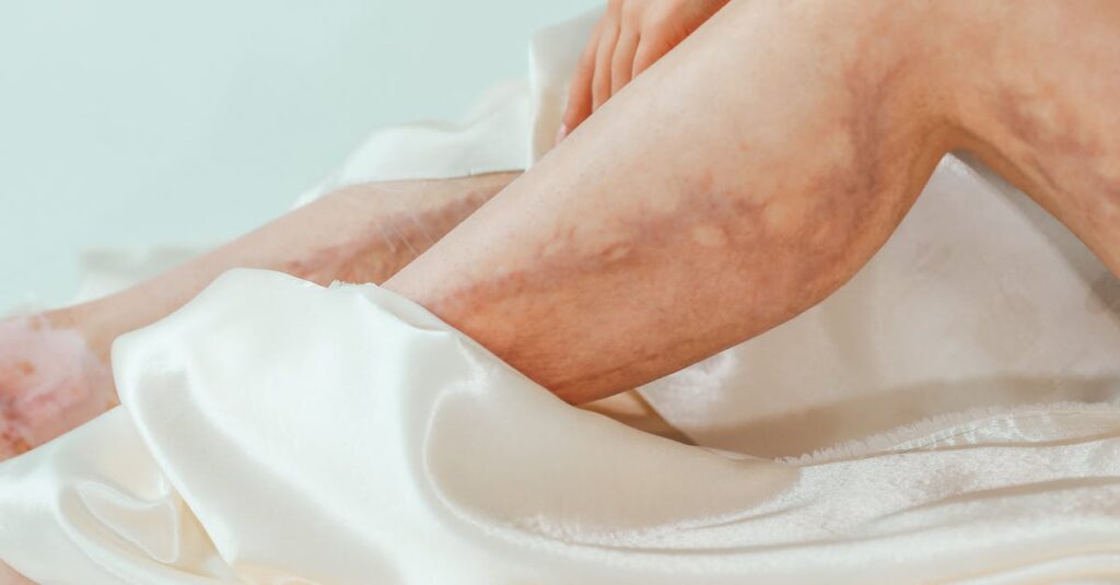 A close-up view of a woman's legs with varicose veins wrapped in a luxurious satin blanket. Health and skincare concept.